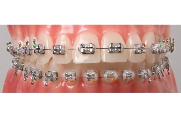 Orthodontics (Braces) in Mumbai