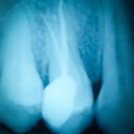 Root canal treatment in Mumbai