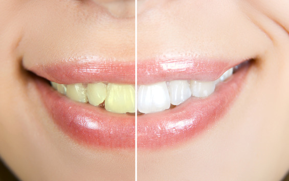 Teeth Whitening